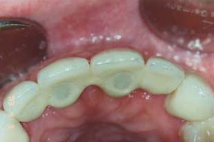 Zahnimplantate: ästhetische Lösung